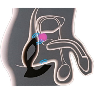 Plug prostate EXPANDER X2 large en place